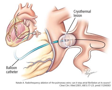 Ablation Of Atrial Fibrillation Facts For The Referring Physician