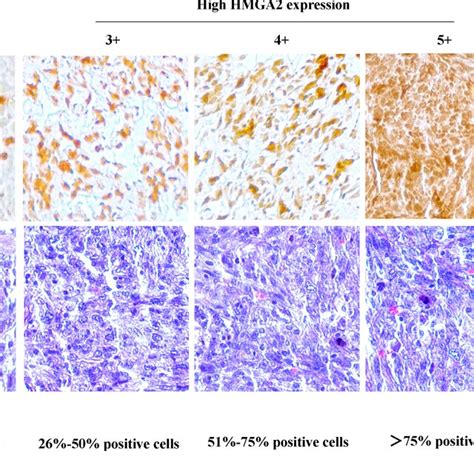 Expression Of Hmga2 In Osteosarcoma Cell Lines And Specimens A