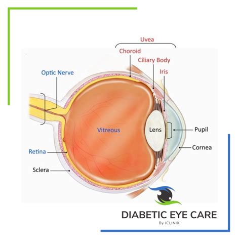 Uveitis Treatment Diabetes Eye Care