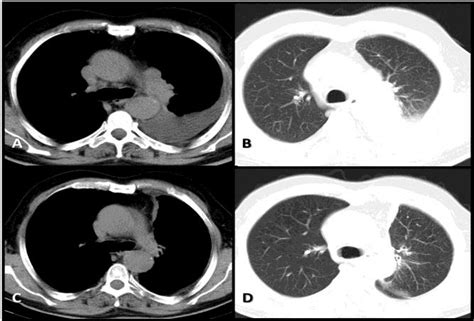 A B C And D Progression Of Primary Lesion Before Erlotinib