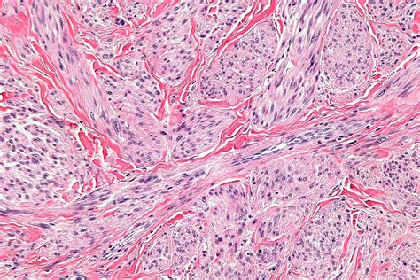 Leiomyosarcoma pathophysiology - wikidoc