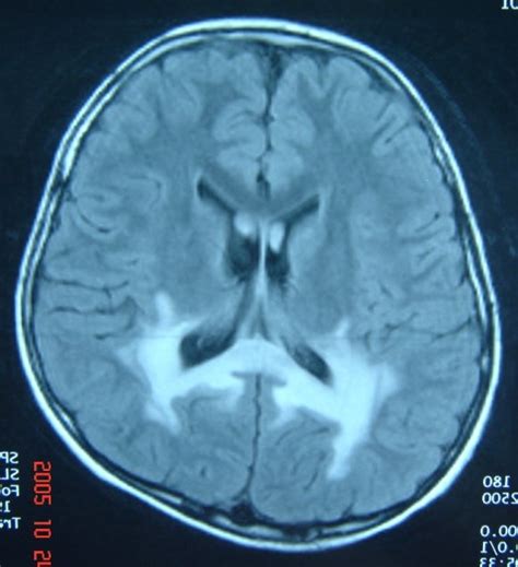 MRI showing early demyelination involving the periventricular region ...