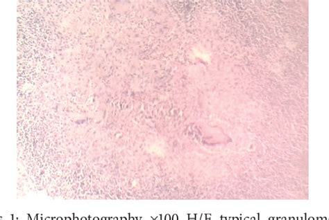 Figure From The Role Of Pcr In Diagnosis Of A Rare Appendicular