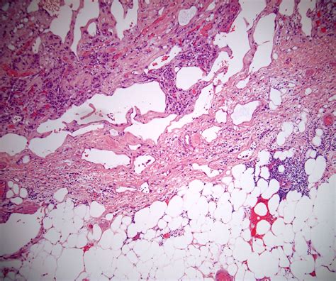 Pathology Outlines Adenomatoid Tumor