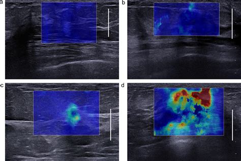 Clinical Application Of Qualitative Assessment For Breast Masses In