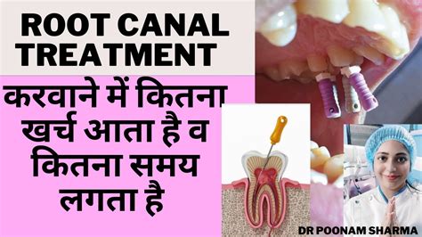 Root Canal Treatment म कतन खरच व समय लगत ह Root Canal