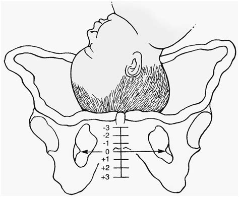 Understanding Fetal Station and Descent