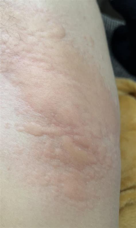 Random recurring rash all over the body : r/DermatologyQuestions