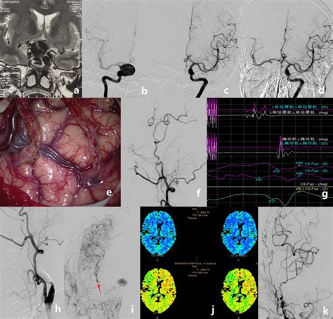 A Hybrid Strategy For Patients With Complex Cerebral Aneurysm Sta Mca