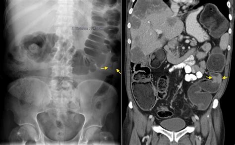 Large Bowel Obstruction Radiology At St Vincent S University Hospital