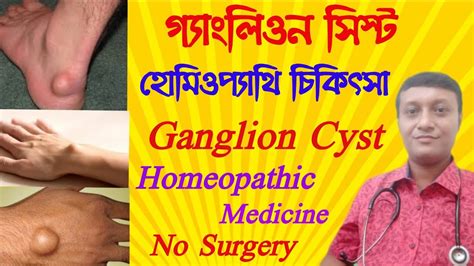 Ganglion Cyst Causes Symptoms Prevention Treatment In Homeopathy By