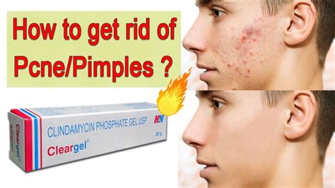 How To Get Rid Of Acne Pimples ♥ Clear Gel Review In Hindi Bunny