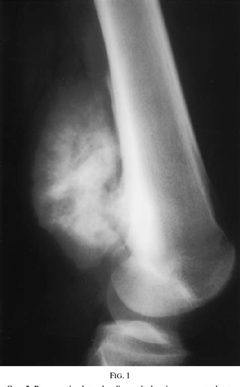 Figure 1 From Parosteal Osteosarcoma Of The Posterior Aspect Of The