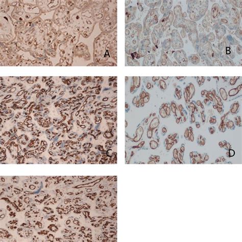 Representative Immunohistochemical Stains Of Placenta In Our Case Vegf