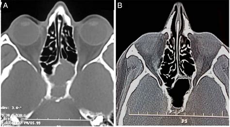 Isolated Acute Sphenoid Sinusitis Presenting With Hemicranial Headache And Ipsilateral Abducens