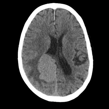 Solitary Fibrous Tumor Hemangiopericytoma Radiology Case