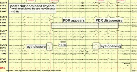 Alpha Rhythm