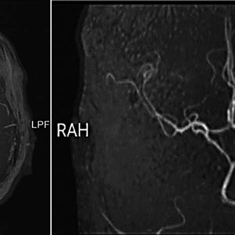 Magnetic Resonance Angiography Showing Occluded Right Proximal Internal