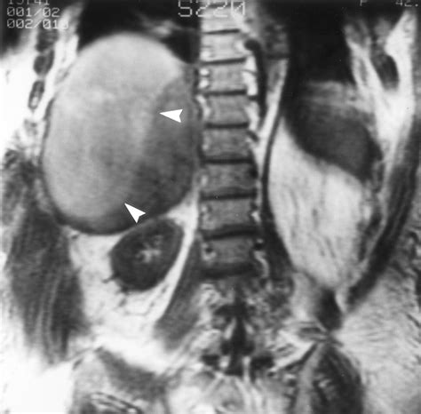 Ct And Mr Imaging Of Benign Hepatic And Biliary Tumors Radiographics