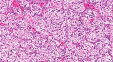 Clear cell renal cell carcinoma | Ottawa Atlas of Pathology