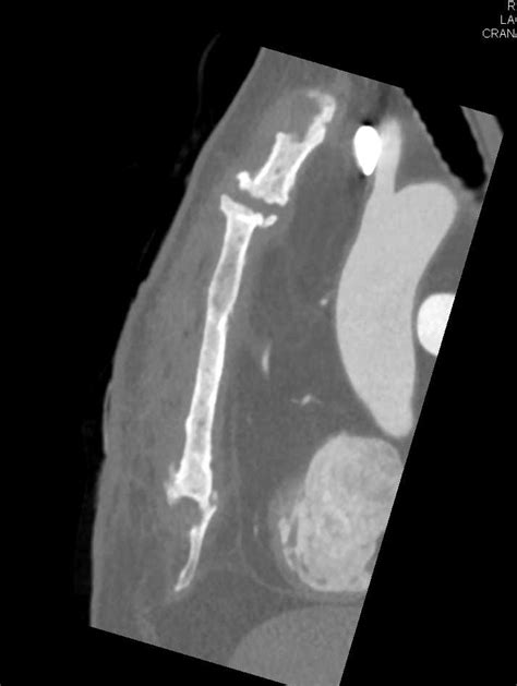 Sternal Osteomyelitis With Inflammation Musculoskeletal Case Studies