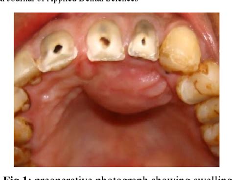 Figure 1 From Radicular Cyst A Case Report Semantic Scholar