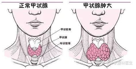 甲状腺结节伴钙化就是甲状腺癌吗？ 知乎