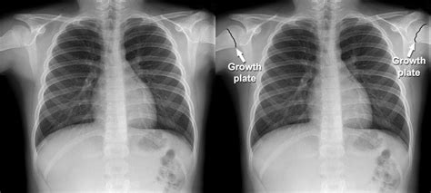 Normal Chest X Ray Anatomy Tutorial Kenhub 43 Off