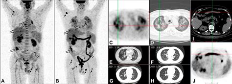 Pet Scan Colon Cancer