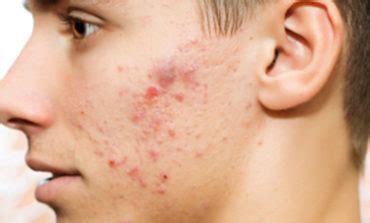 Acne – A Serious Disease of the Skin – HealthGoesUp.com