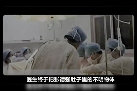 重庆一男子“意外怀孕”，医生剖腹产后发现，肚子里好像是女孩 肚子 医生 男子