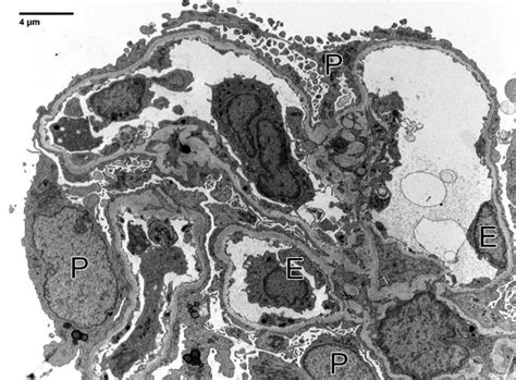 Electron microscopy: one non-obsolescent glomerulus was subjected to ... 
