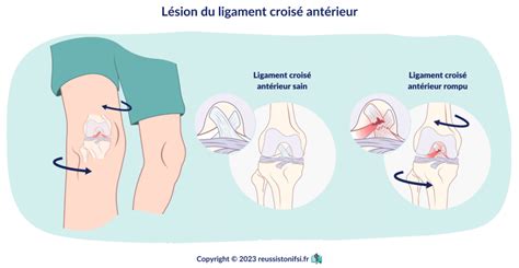 Guide Pratique Du Stage Infirmier En Chirurgie Orthop Dique