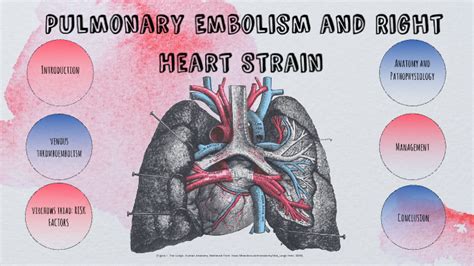 Saddle Pulmonary Embolism Diagram