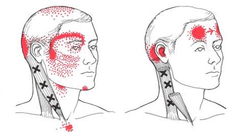 Pain in face and jaw caused by trigger points