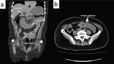 Rigler Triad In Gallstone Ileus Case Report And Literature Review