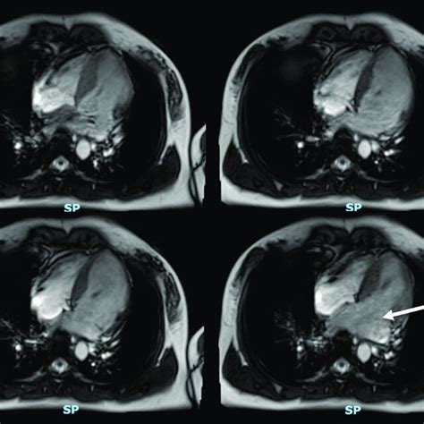 Severe mitral regurgitation on cardiac magnetic resonance imaging ...