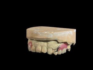 Types of Partial Dentures