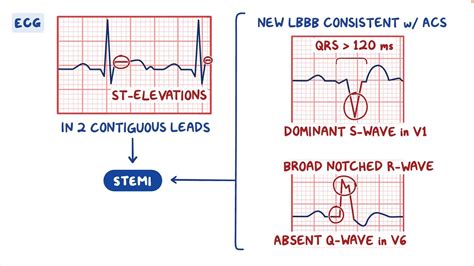 Acute Coronary Syndrome Clinical Sciences Osmosis Video Library