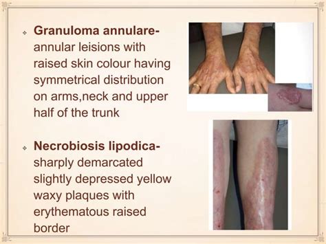 Dermatological Manifestation Of Systemic Diseases Ppt