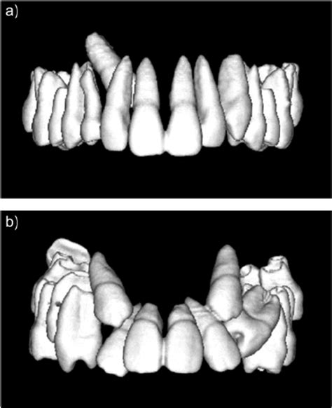 An Example Of Buccal And Palatal Impaction Of The Maxillary Canine In