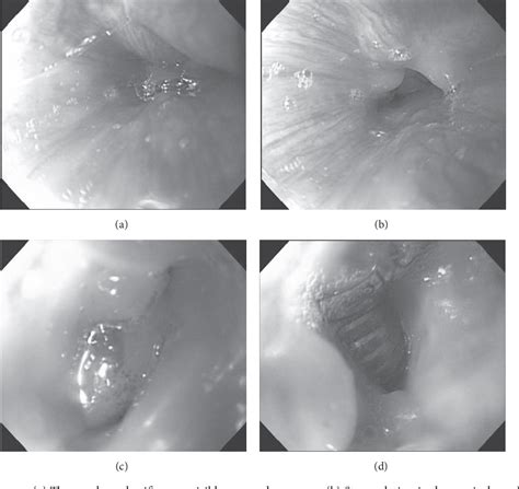 Figure 1 from Tracheoesophageal Fistula due to a Damaged Tracheal Stent ...