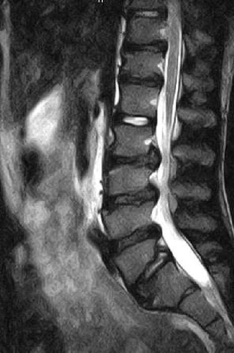 Lumbar Disc Disease Mri