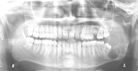 Orthopantomograph Shows A Welldefined Multilocular Radiolucency On The