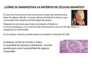 Arteritis De Celulas Gigantes Y Polimialgia Reumatica Doctor Farid