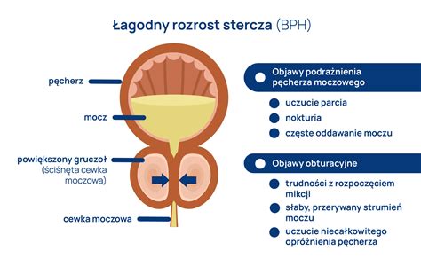 Przerost Prostaty Jakie S Objawy Przyczyny I Leczenie Przerostu