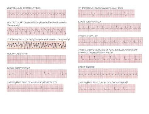 Cardiac Rhythm Examples - Etsy