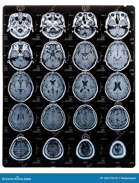 A Ct Brain Scan Of A Patient With Multiple Fractures Epidural Hematoma