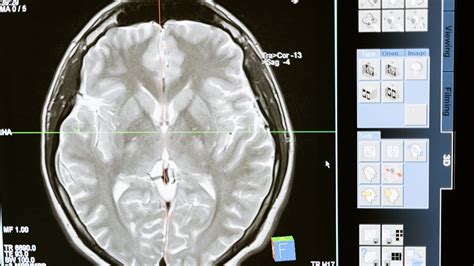 Types of Benign Brain Tumors