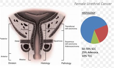 Ureteral Cancer Urethral Cancer Bladder Cancer, PNG, 1462x873px ...